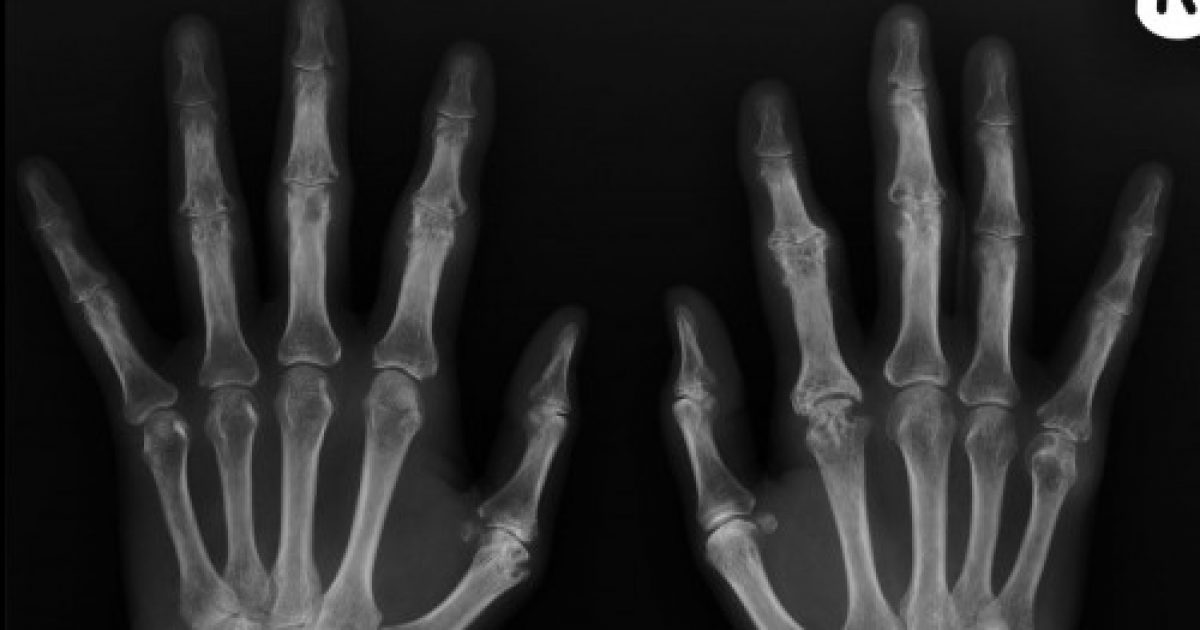 Arthritis of the Hands and Upper Extremities – Thrive Magazine