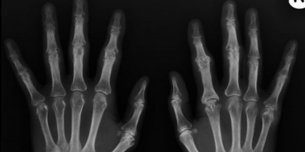 Arthritis of the Hands and Upper Extremities – Thrive Magazine