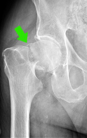 male-hip-fracture-s-meisterling