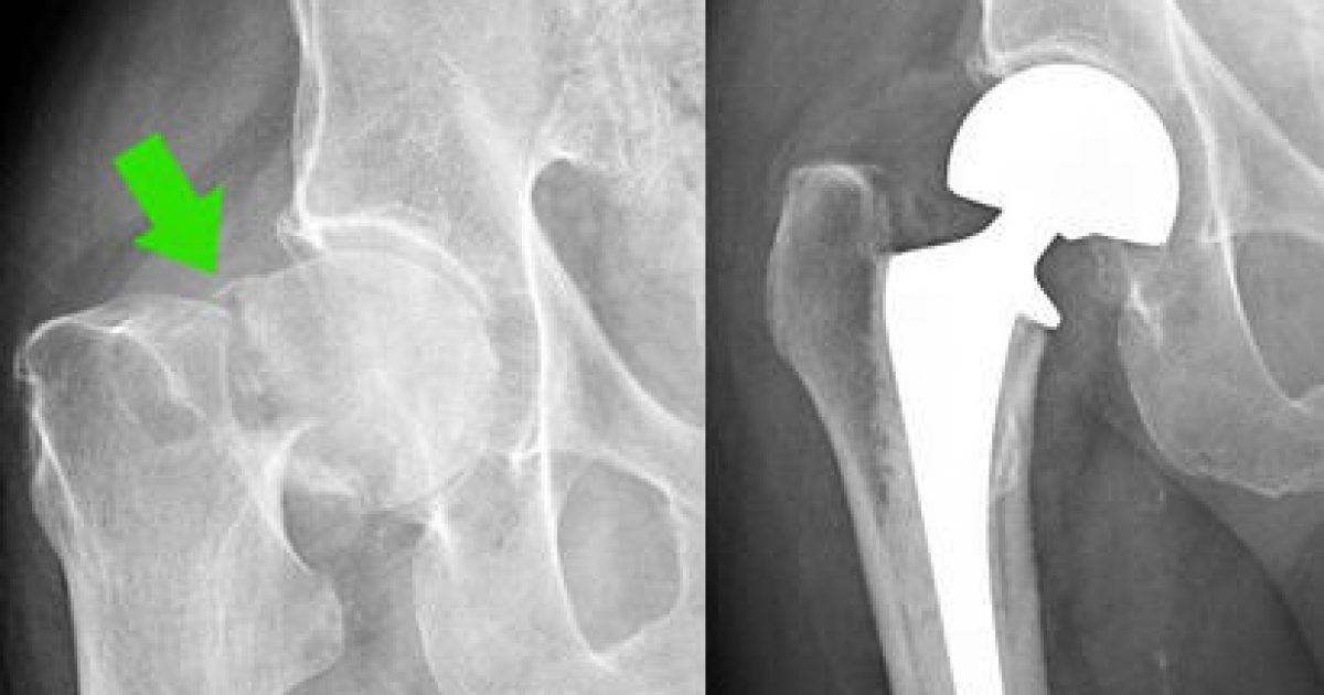 Osteoporosis Case Study #1: Hip Fracture of the Femoral Neck