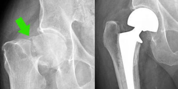 Osteoporosis Case Study #1: Hip Fracture of the Femoral Neck