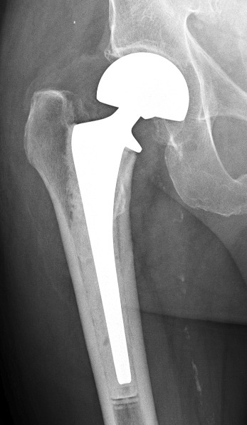 partial-hip-replacement-male-s-meisterling