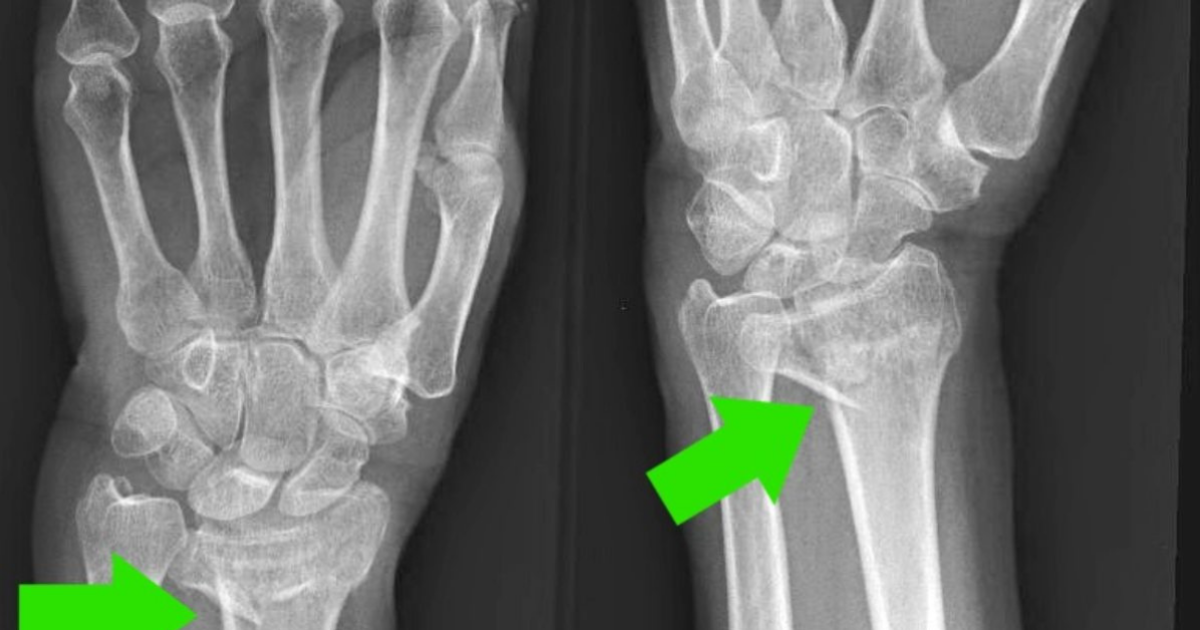 Osteoporosis Case Study #2: Radius Wrist Fracture