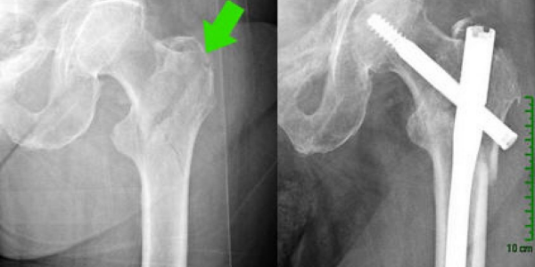 Osteoporosis Hip x